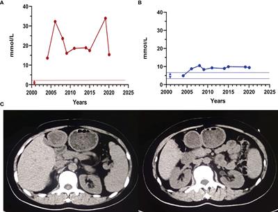 Identification and Characterization of Two Novel Compounds: Heterozygous Variants of Lipoprotein Lipase in Two Pedigrees With Type I Hyperlipoproteinemia